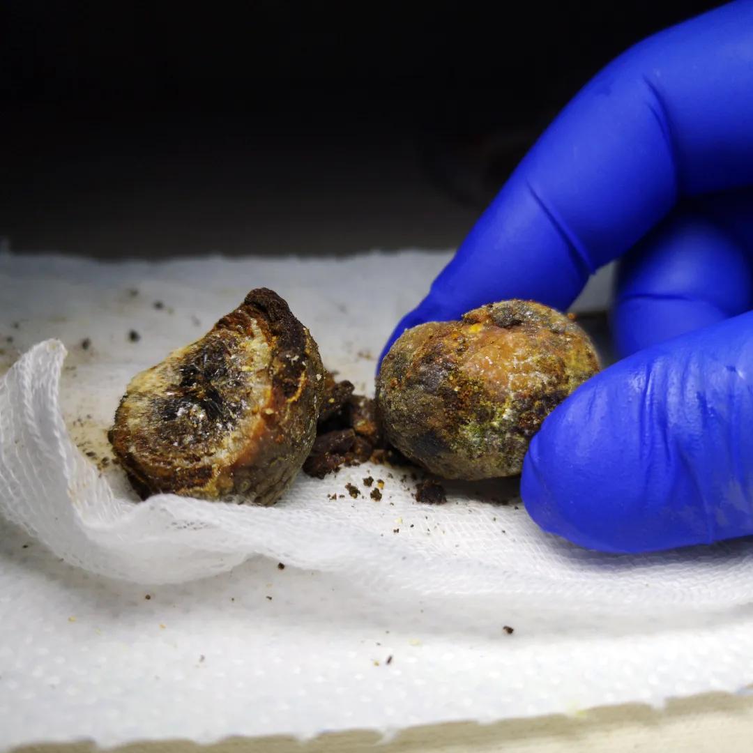 Gallstones